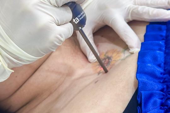 Xăm hình che sẹo lồi gây kích ứng