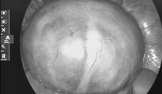 Đau bụng tưởng nhẹ, người phụ nữ sốc nặng khi bác sĩ lấy ra thứ “rợn người” trong cơ thể