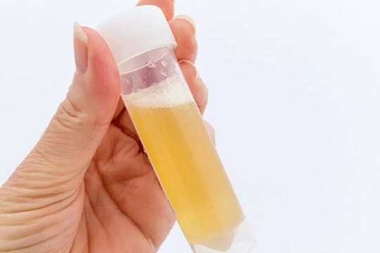 Nước tiểu có bọt như bia cảnh báo thận suy yếu