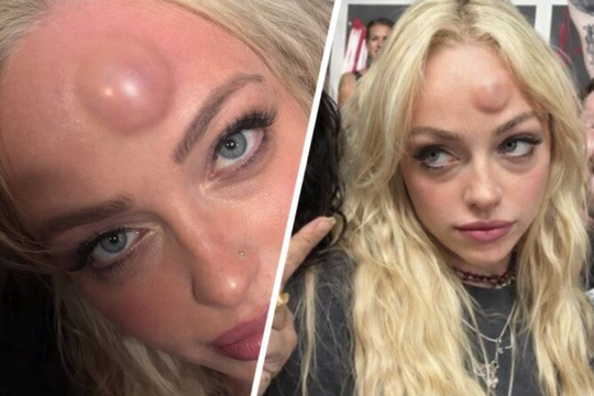 Sao nữ WWE người Mỹ chấn thương lạ trên trán