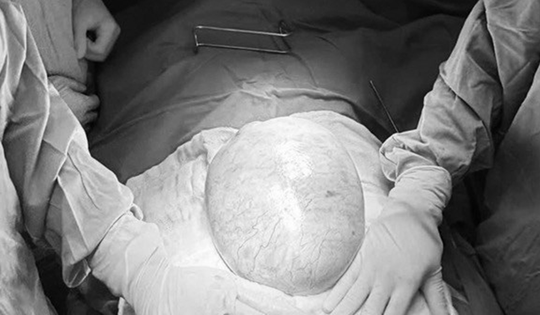 Bé gái 13 tuổi bụng to bất thường, bố mẹ sốc khi phát hiện bí mật "đáng sợ" bên trong