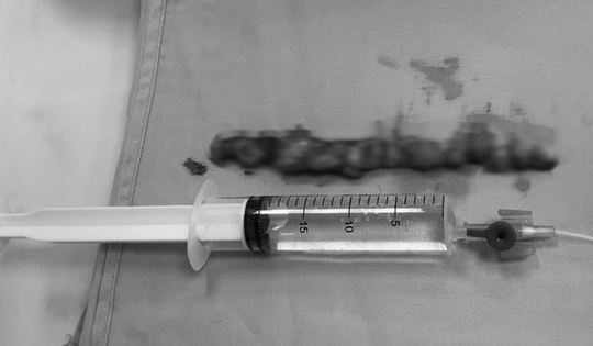 Đau lưng kéo dài tưởng xương khớp, người phụ nữ tá hỏa khi biết mình mắc bệnh nguy hiểm