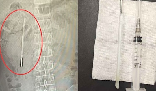 Đau bụng đi khám, người đàn ông sốc nặng khi thấy thứ bên trong