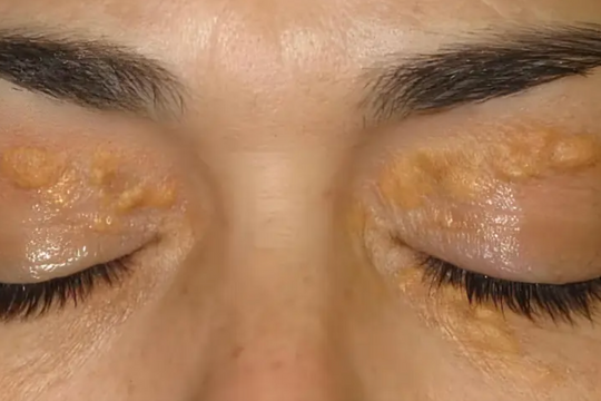 2 dấu hiệu trên mặt cảnh báo cholesterol xấu chạm ngưỡng nguy hiểm