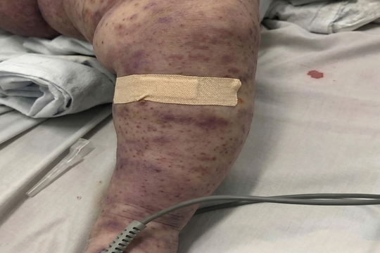 4 ca tử vong do não mô cầu, Bộ Y tế cảnh báo dịch