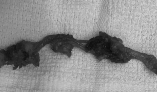 Đau âm ỉ vùng bụng, người đàn ông sốc nặng khi bác sĩ lấy ra thứ "rợn người" trong cơ thể