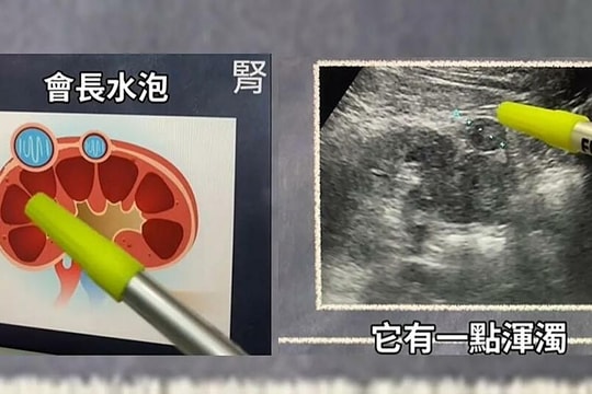 Điểm mờ trên siêu âm bụng tiết lộ khối u ác tính ở thận