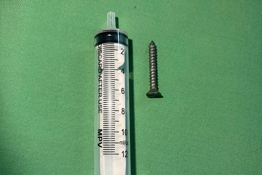 Bé gái nuốt đinh vít dài 2,5 cm