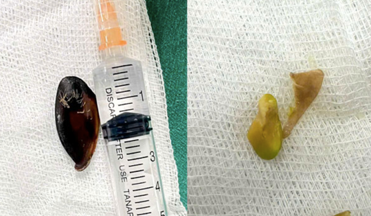 Bé 14 tuổi ho khan kéo dài, gia đình sốc khi bác sĩ lấy ra dị vật bên trong cơ thể