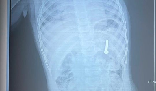 Đang chơi ở nhà, bé gần 2 tuổi nuốt phải thứ "đáng sợ"