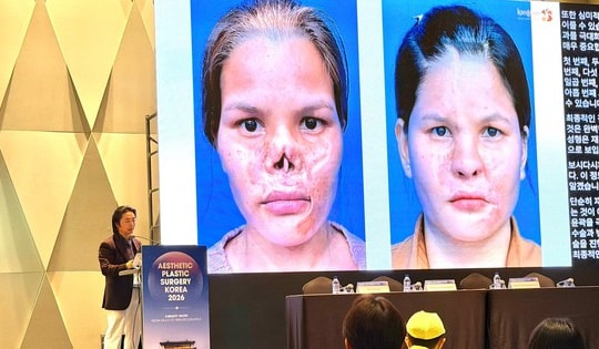 Giải pháp điều trị biến chứng sau nâng mũi gây chú ý tại Hội nghị thẩm mỹ quốc tế APS Korea 2026