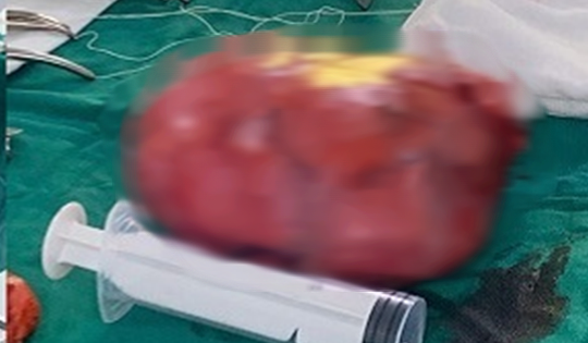 Đau bụng tưởng nhẹ, người phụ nữ sốc nặng khi bác sĩ lấy ra thứ “đáng sợ” trong bụng