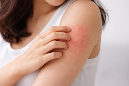 5 thay đổi trên da có thể cảnh báo bệnh gan