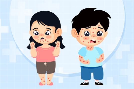 Triệu chứng nặng bệnh tay chân miệng khác thủy đậu thế nào