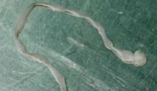 Người phụ nữ lên cơn co giật, bác sĩ lấy ra thứ đáng sợ trong não