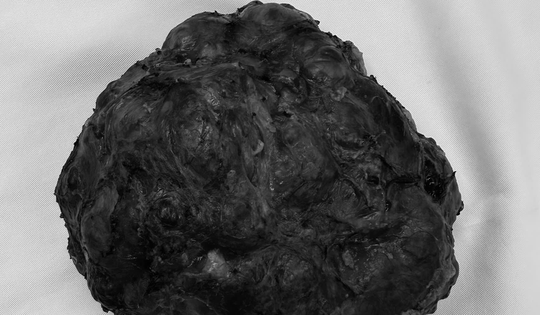 Cô gái trẻ 26 tuổi vòng một to bất thường, bác sĩ phát hiện bí mật bên trong