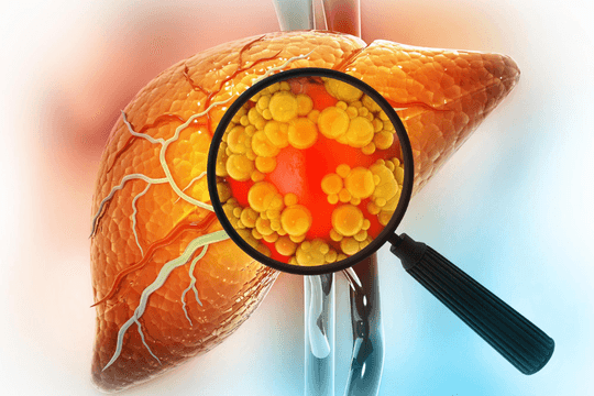 Nghiên cứu mới từ Mỹ mở ra cách điều trị gan nhiễm mỡ không cần ăn kiêng khắt khe