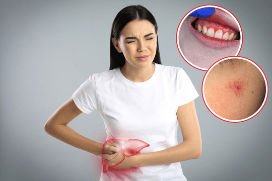 Vì sao bệnh gan có thể gây chảy máu chân răng và xuất hiện nốt mạch hình nhện trên da?