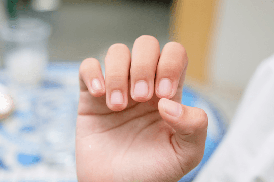 Thấy dấu hiệu lạ ở móng tay, khi nào bạn không nên chủ quan?