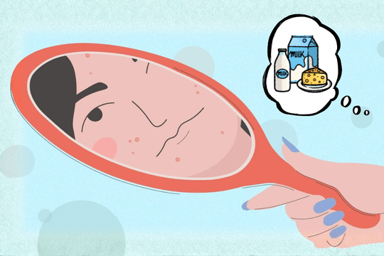 Sữa có phải là thủ phạm khiến mụn bùng phát?