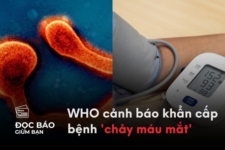 4/9/2025 | WHO cảnh báo khẩn cấp bệnh 'chảy máu mắt'. Kiểu tính cách dễ bị tăng huyết áp