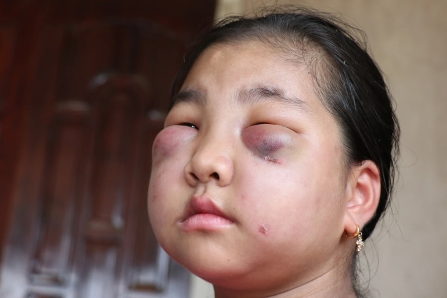 Cuốn bệnh án đẫm nước mắt của người mẹ nghèo có con gái mắc bệnh lạ