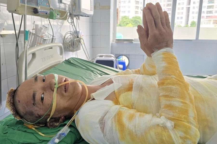 Người bố trẻ dân tộc Mông bỏng 64% cơ thể chắp tay khẩn cầu: “Xin cứu em!”