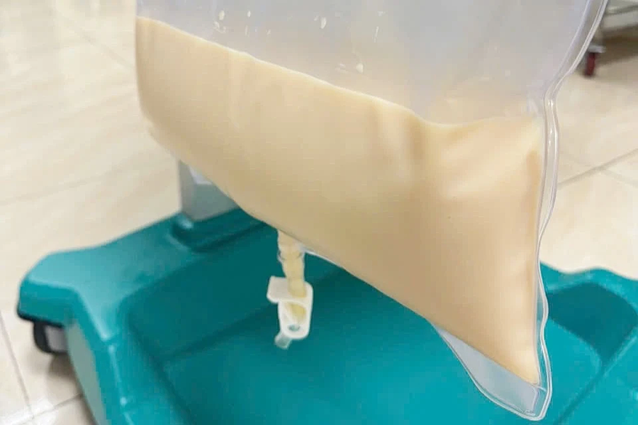 Mỡ máu tăng 80 lần, huyết tương trắng đục như sữa