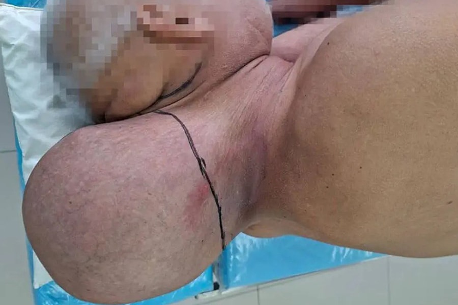 Người đàn ông mang 'cái đầu thứ hai' sau gáy trong 16 năm