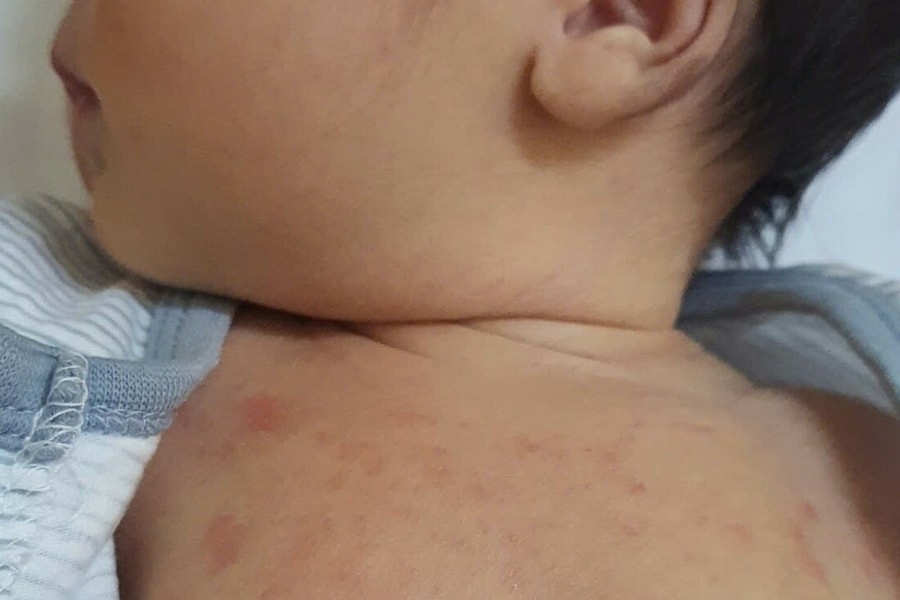 Vì sao trẻ sơ sinh có mụn sữa?