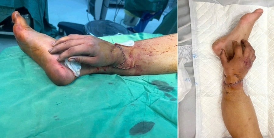 Ca ghép bàn tay vào cẳng chân của sản phụ song thai hồi phục tốt