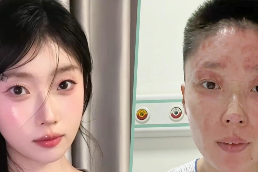 Bỏng nặng suýt mất tất cả, cựu mẫu gây sốt với nghề mới