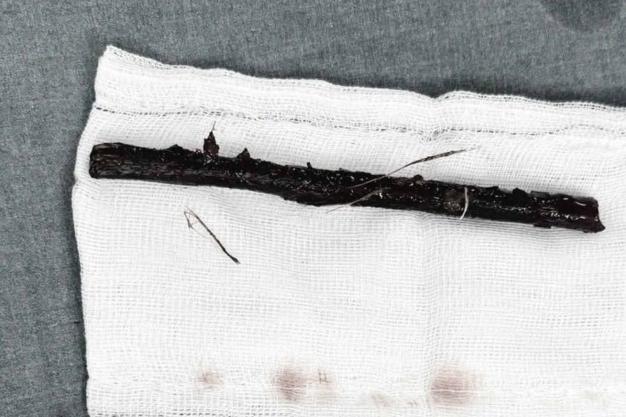 Bé gái mang nhánh cây dài 16 cm trong bụng suốt 4 tháng