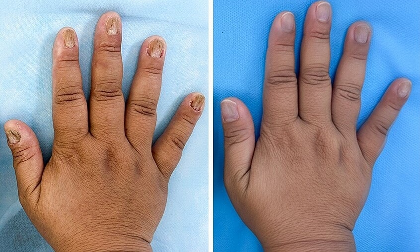 Nấm làm biến dạng móng tay chân người phụ nữ