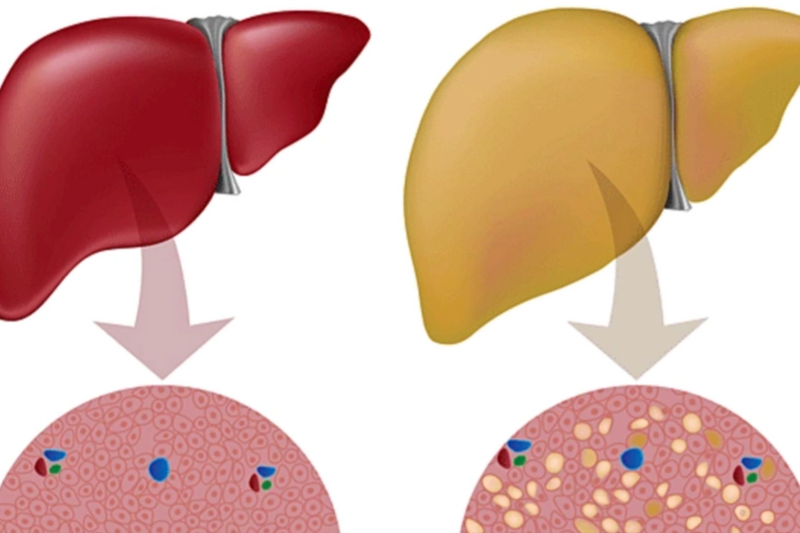 5 cách tự kiểm tra gan nhiễm mỡ tại nhà