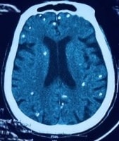 Nang sán dây lợn 'phát sáng' khắp cơ thể người phụ nữ