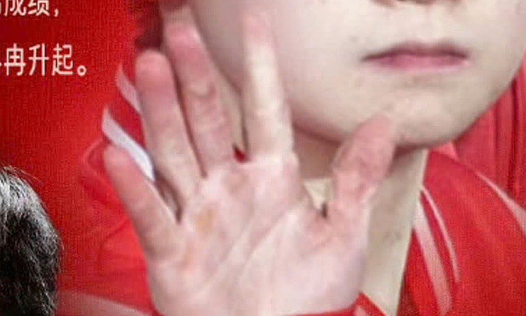 Bàn tay biến dạng của ngôi sao bóng bàn Trung Quốc