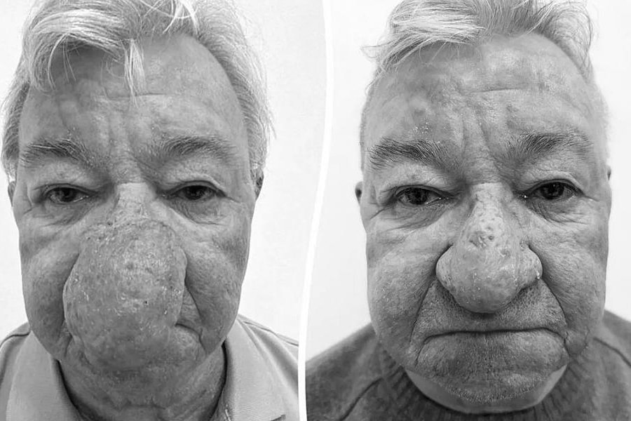 6 năm không thể hôn vợ vì mũi 'sư tử' che kín miệng