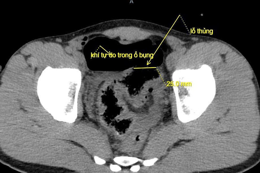 Dùng vòi nước rửa ôtô xịt hậu môn gây thủng đại tràng