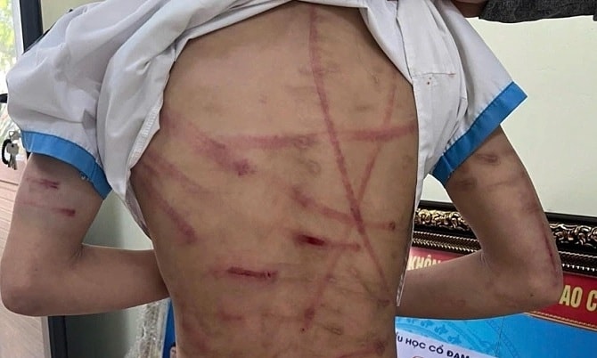 Bi kịch của những đứa trẻ bị bạo hành