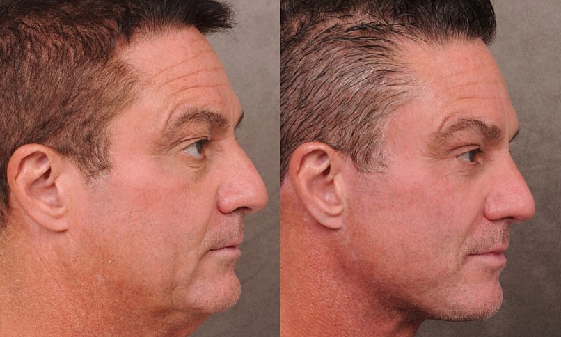 Áp lực 'già là đào thải', kỹ sư công nghệ đổ tiền thẩm mỹ