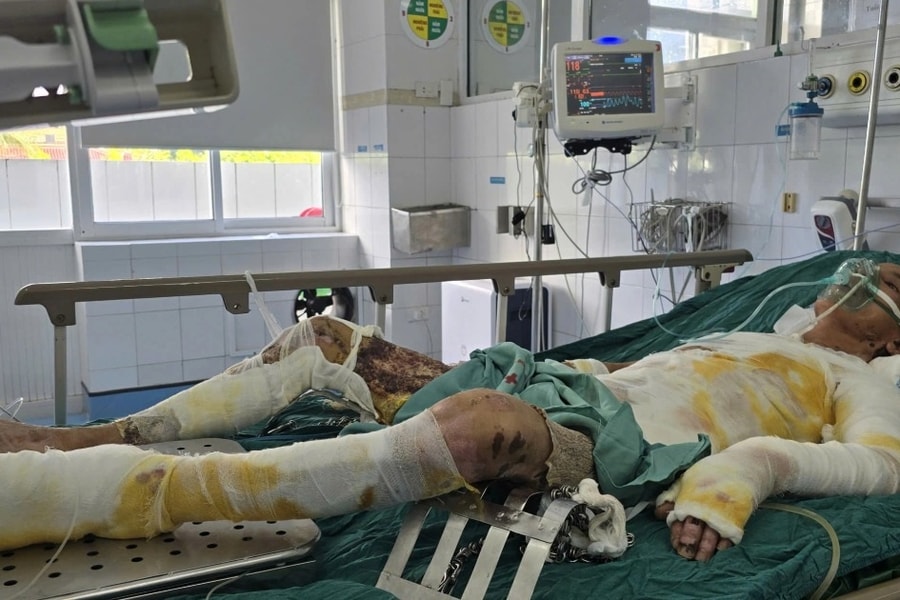 Ngã vào chảo mỡ bò đang sôi, người bố 2 con bỏng 75% cơ thể