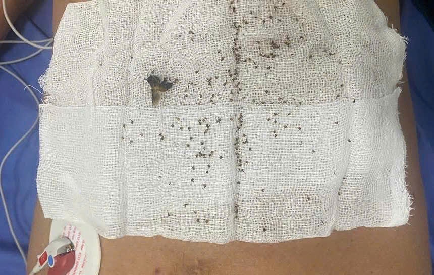 Thoát chết sau khi bị hơn 300 con ong khoái đốt