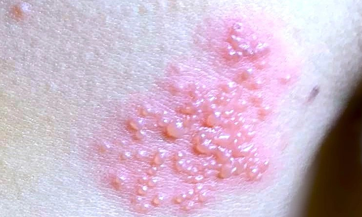 Bỏng rát, đau như kim châm sau khi khỏi zona thần kinh