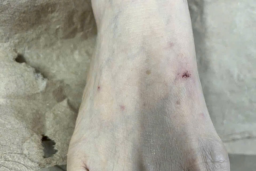 Nhập viện vì tự 'giải độc' vết mèo cắn bằng nước chanh