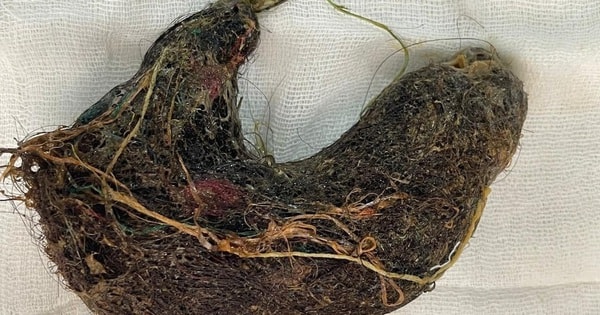 Bé trai đau bụng suốt 2 tháng, bác sĩ phát hiện ra "bí mật" đáng sợ