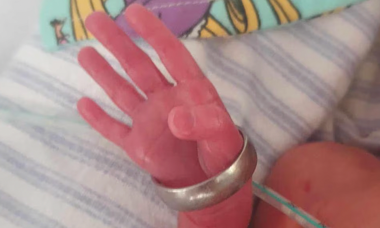 Cuộc hồi sinh của bé gái sinh non 26 tuần, nặng gần 900 gram