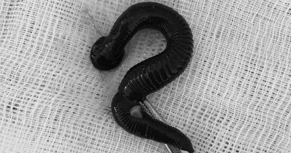 Cụ bà 72 tuổi ngứa mũi liên tục, bác sĩ gắp ra thứ "đáng sợ" bên trong