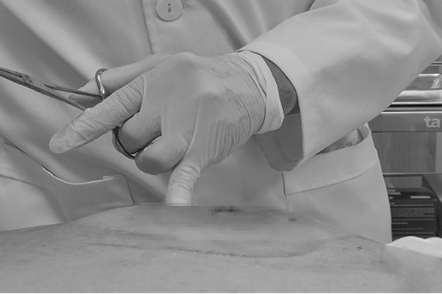 Vết ong đốt nhiễm trùng mới biết mắc bệnh tiểu đường