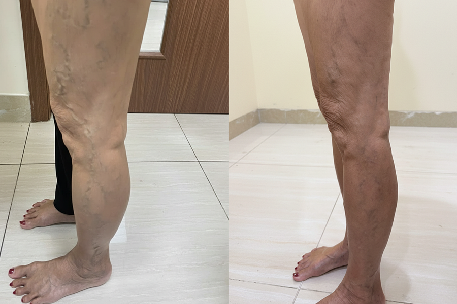 Chích xơ chữa suy giãn tĩnh mạch cho người tiểu đường